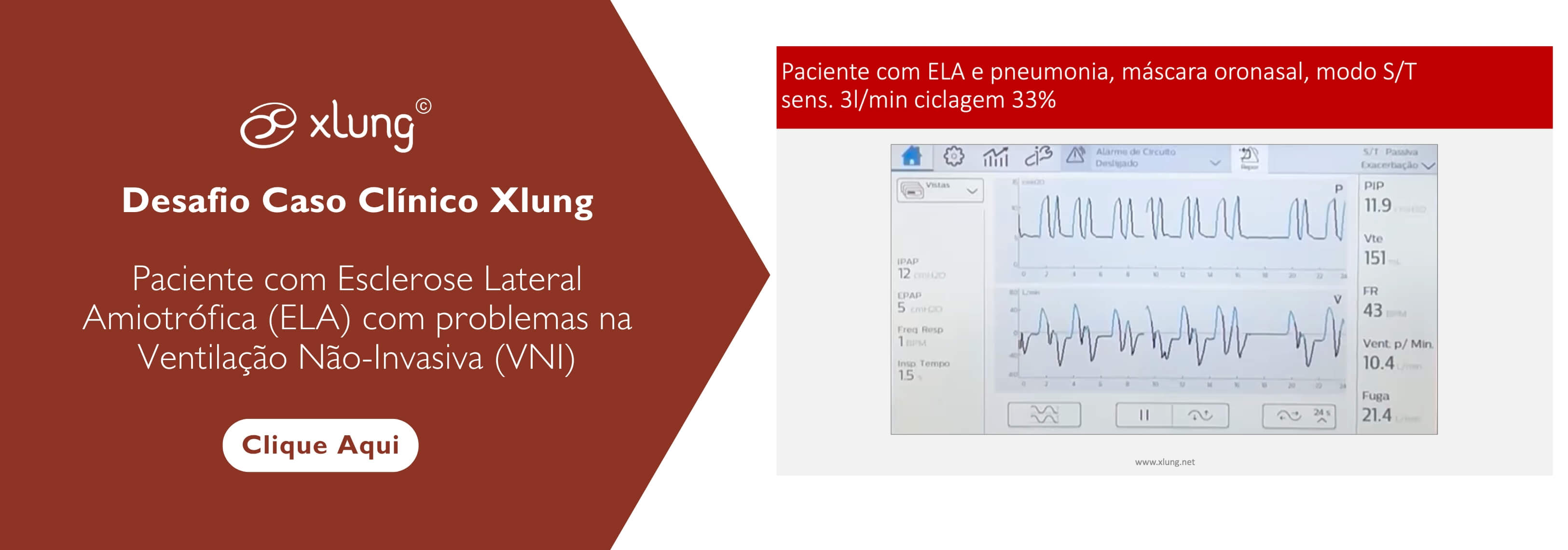 Banner_-_desafio_clinico_esclerose_lateral_ela_com_problemas_vni_ptbr
