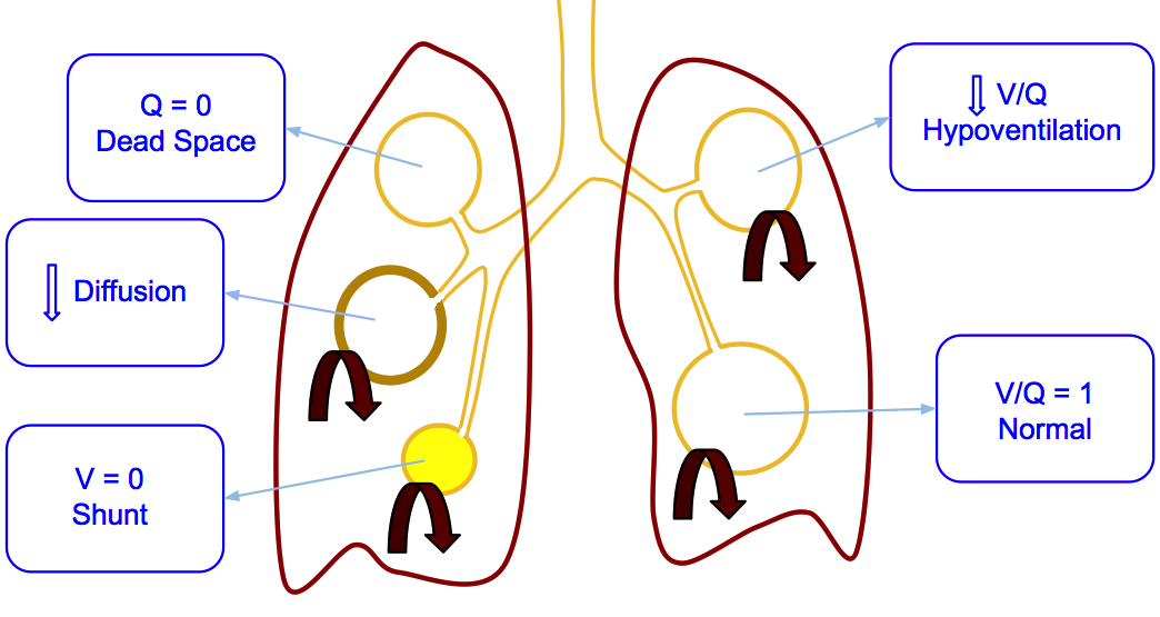 V/Q dysfunction mechanisms in the pulmonary parenchyma may cause hypoxemia and/or hypercapnia.