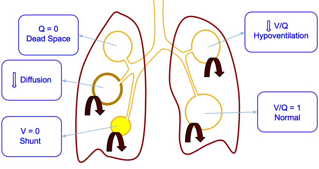 hypoxemia图片