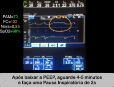 video aula Manobra de Recrutamento Alveolar Máximo e Titulação Decremental da PEEP no modo VCV