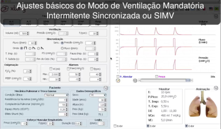 Ventilação Mandatória Intermitente Sincronizada - SIMV