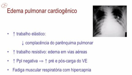 Vni Pulmao Cardiogenico