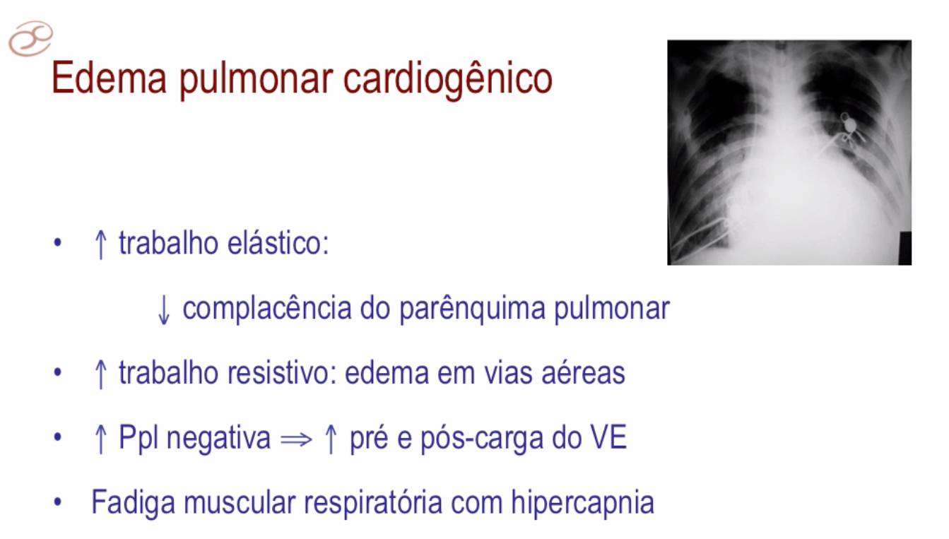 Vni_pulmao_cardiogenico