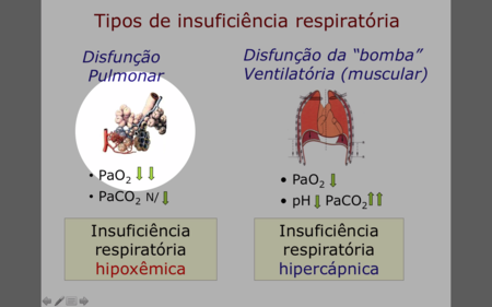 Insuficiencia Respiratoria Hipoxemica